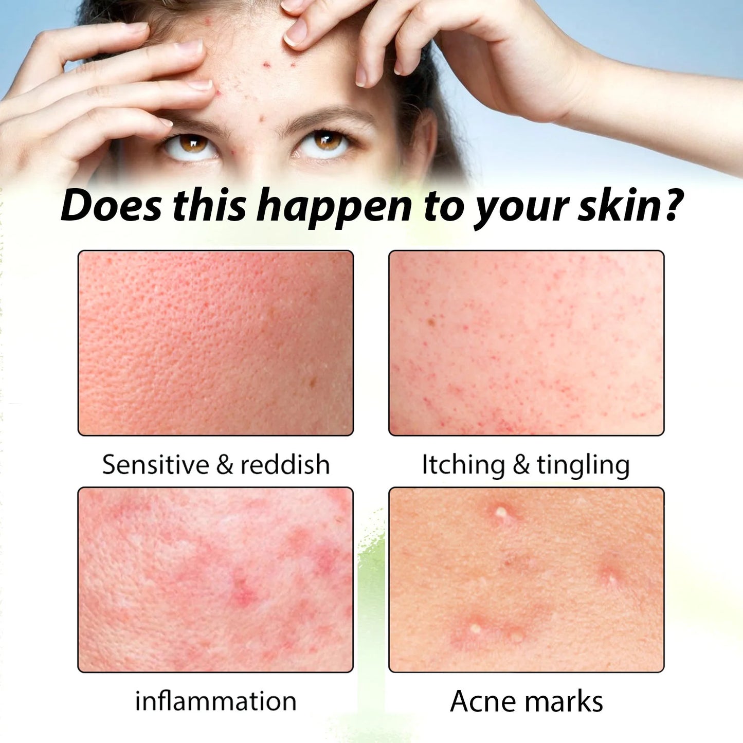 Acne Face Cream Pimple Treatment Oil Control Repair