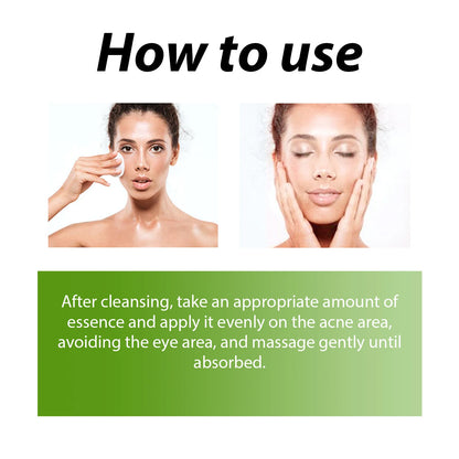 Acne Face Cream Pimple Treatment Oil Control Repair